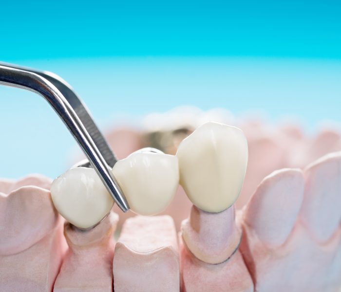 closeup-prosthodontics-prosthetic-teeth-crown-bridge-implant-dentistry-equipment-model-express-fix-restoration