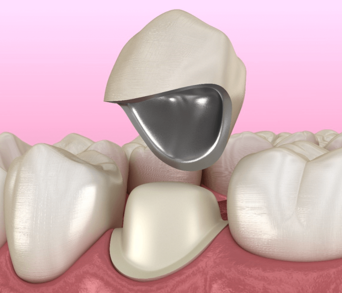 pfm-dental-crown